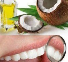El aceite de coco ayuda a quitar las bacterias que causan caries dentales