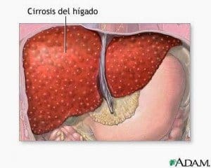 cirrosis