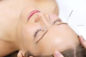 ¿Qué tipos de acupuntura existen?