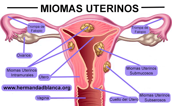 natural para los miomas uterinos tratamiento natural para los miomas uterinos ID206599 - hermandadblanca.org